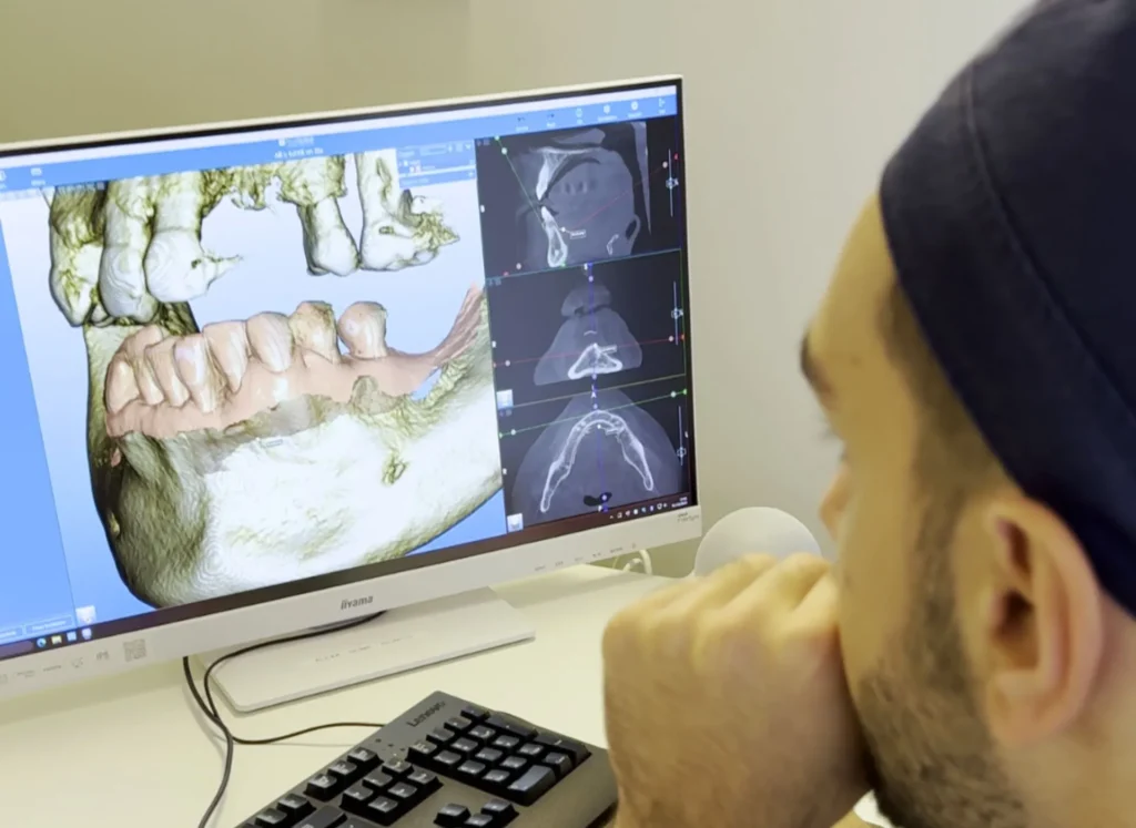 Implantologia computer guidata: spiegata semplice 1 Implantologia computer guidata